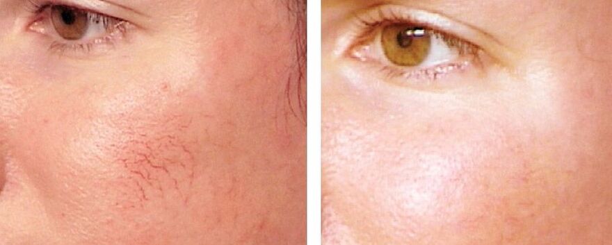 Penghapusan Rosacea