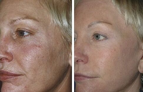 peremajaan laser fraksional sebelum dan sesudah foto