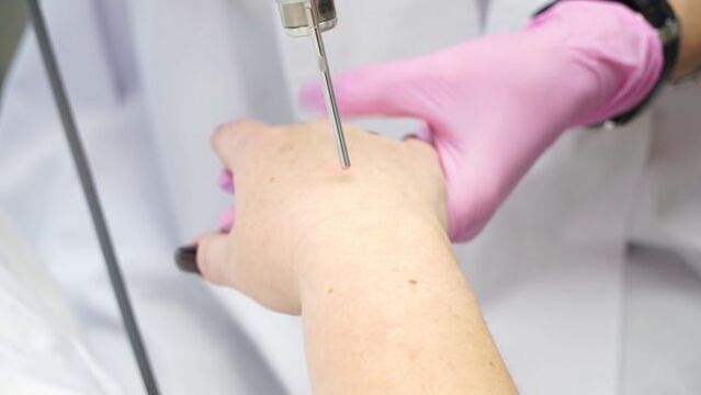 Peremajaan kulit tangan dengan laser