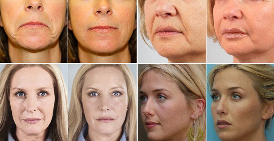 foto wanita sebelum dan sesudah peremajaan kulit wajah